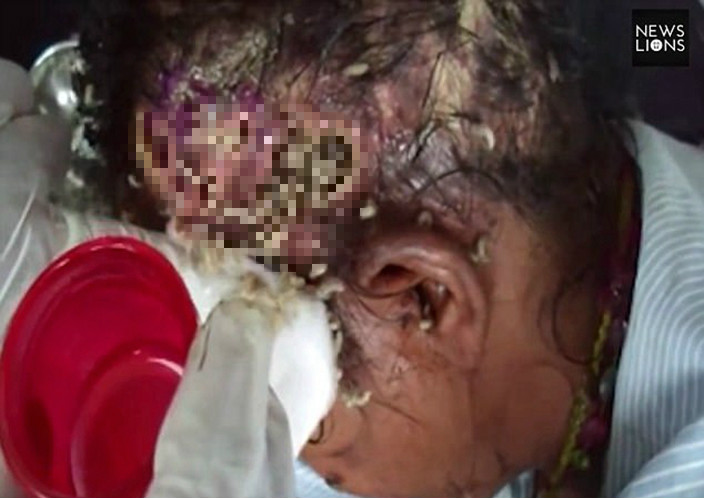 Homeless Indian woman, whose head infested with maggots, saved by ...