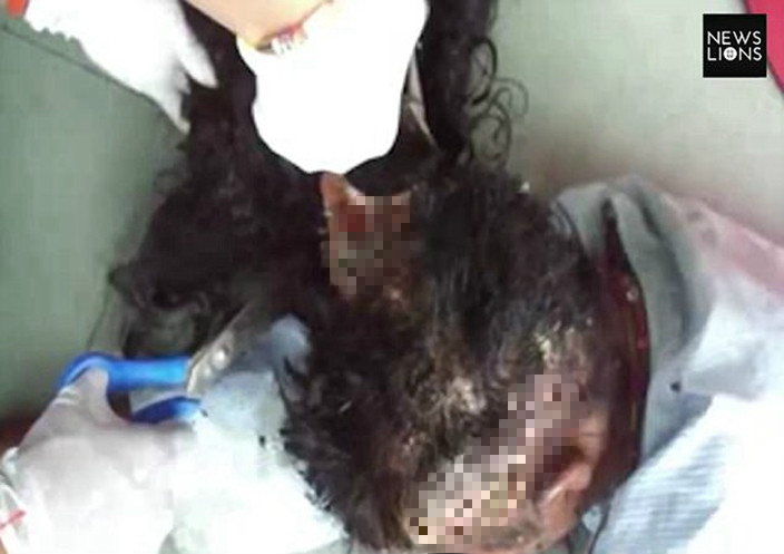 Homeless Indian woman, whose head infested with maggots, saved by ...