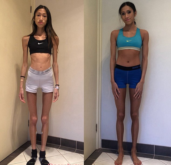 Anorexia Skinny