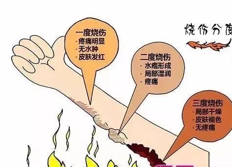 深圳3歲女童燙傷後 奶奶竟拿二鍋頭沖洗傷口